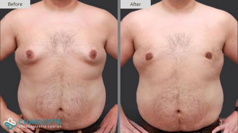 Charlotte Gynecomastia Before and After Patient 137a