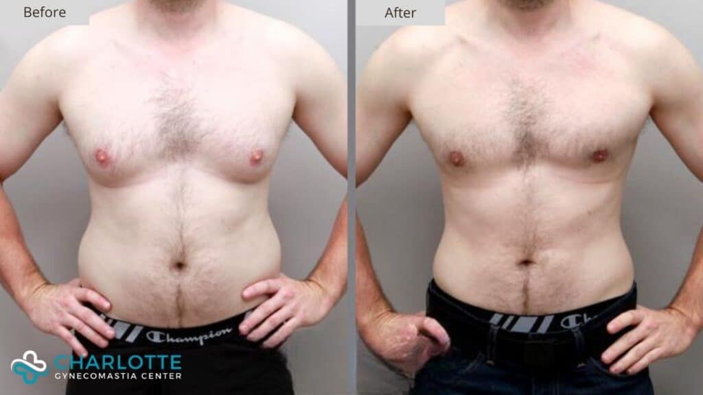 Charlotte Gynecomastia Before and After Patient 141a