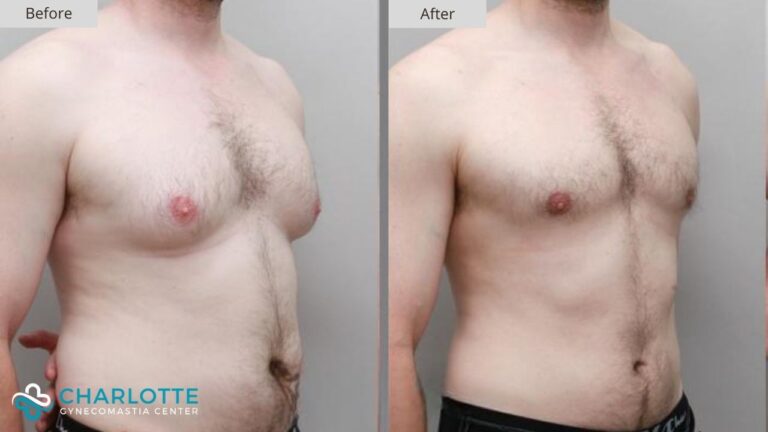 Charlotte Gynecomastia Before and After Patient 141b