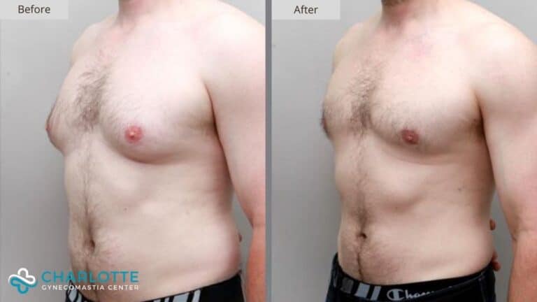 Charlotte Gynecomastia Before and After Patient 141c