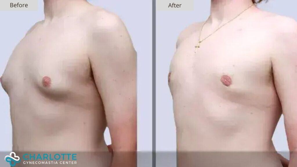 Charlotte Gynecomastia Before and After Patient 144a