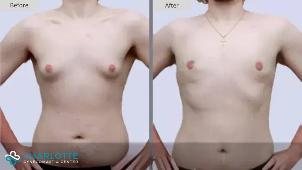 Charlotte Gynecomastia Before and After Patient 144b