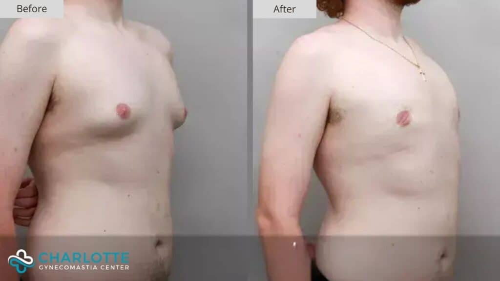 Charlotte Gynecomastia Before and After Patient 144c