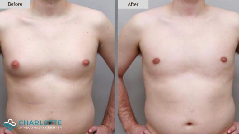 Charlotte Gynecomastia Before and After Patient 145a