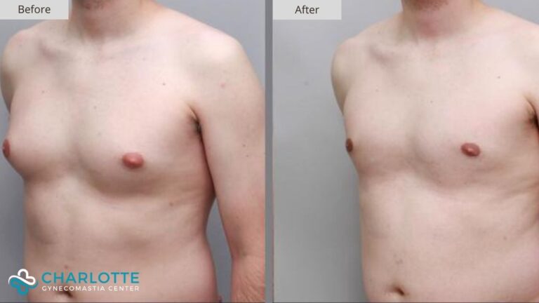 Charlotte Gynecomastia Before and After Patient 145b