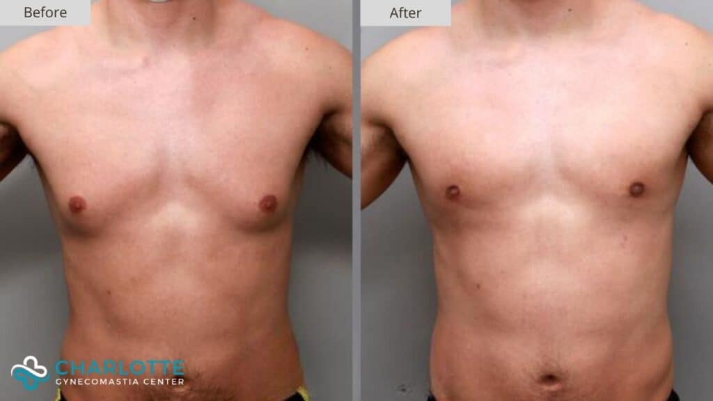Charlotte Gynecomastia Before and After Patient 149a