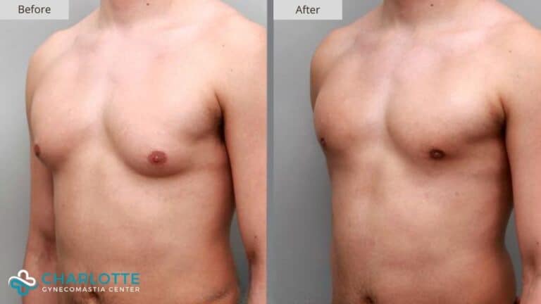 Charlotte Gynecomastia Before and After Patient 149b