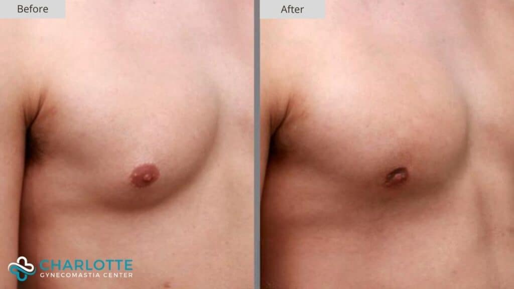 Charlotte Gynecomastia Before and After Patient 149c