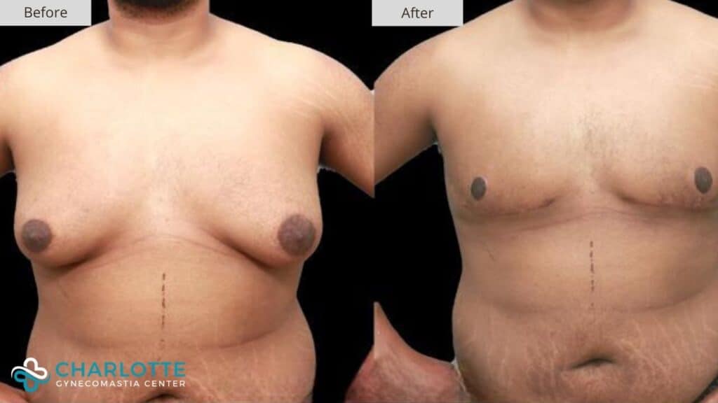 Charlotte Gynecomastia Before and After Patient 155a
