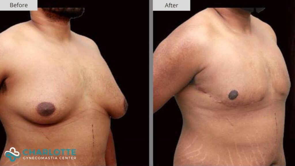 Charlotte Gynecomastia Before and After Patient 155b