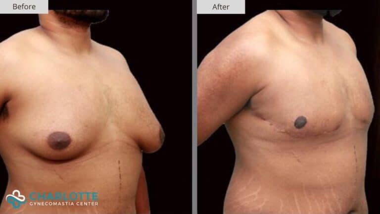 Charlotte Gynecomastia Before and After Patient 155b