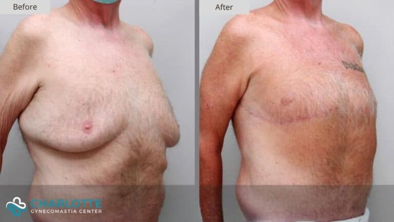 Charlotte Gynecomastia Before and After Patient 158b