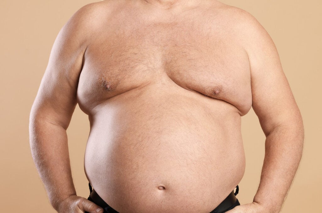 Is gynecomastia genetic