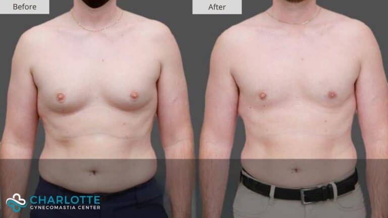 Local Anesthesia Gynecomastia