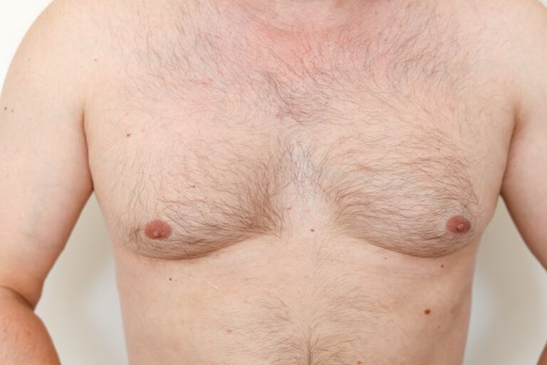 hairy chest with gynecomastia close up